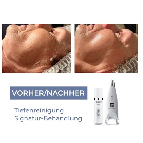 LPG Behandlung für Anti-Aging & Lifting