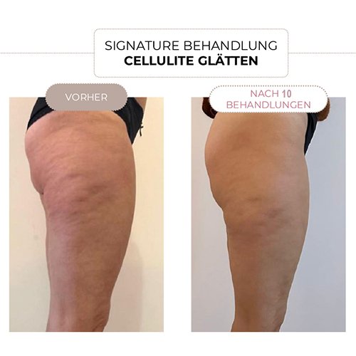 Straffung Signature Körperbehandlung